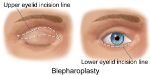 Blepharoplasty EyeLift