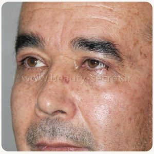 بلفارو پلاستی جراحی افتادگی پلک مردان قبل 3-1