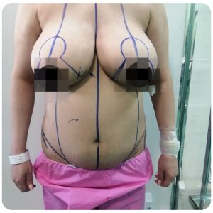 جراحی ابدومینوپلاستی + لیپو ساکشن رفع چربی اضافه شکم پهلو زنان قبل