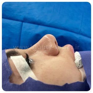جراحی ترمیمی بینی زنان 1 - عکس قبل