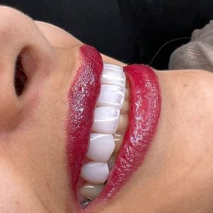 کامپوزیت دندان خانمها بعد