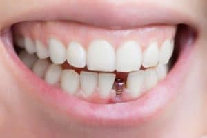 ايمپلنت-دندان