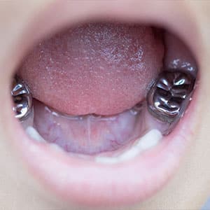 روکش-دندان