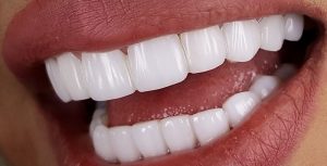 كامپوزيت-دندان