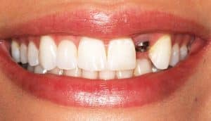 ايمپلنت-دندان