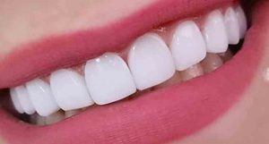 كامپوزيت-دندان