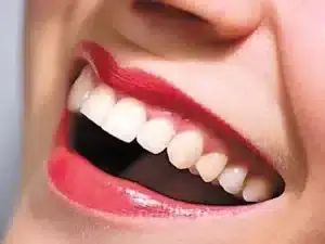 ایمپلنت-دندان