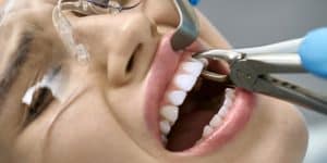 کشیدن-دندان